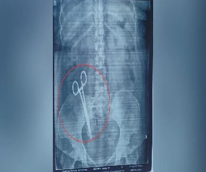 17 साल से महिला के पेट में थी कैंची, X-Ray हुआ तो उड़ गए होश; पति ने दर्ज कराई शिकायत